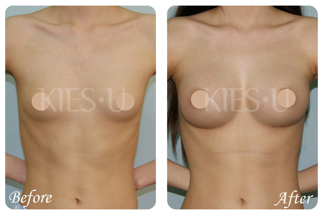 Breast augmentation korea  Dr.Lee Plastic surgery Korea